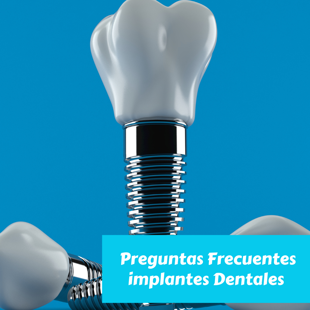 implantes dentales