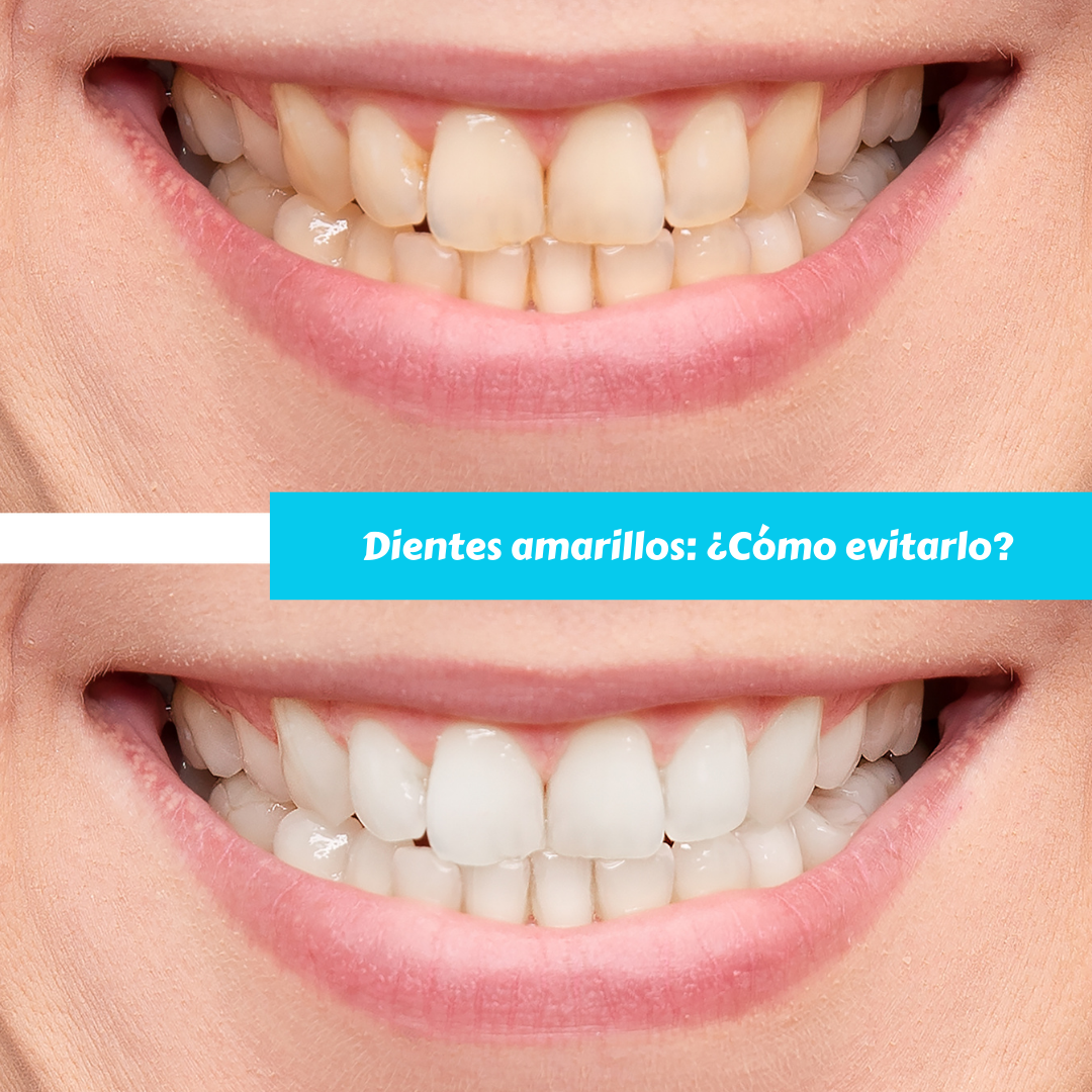Dientes amarillos