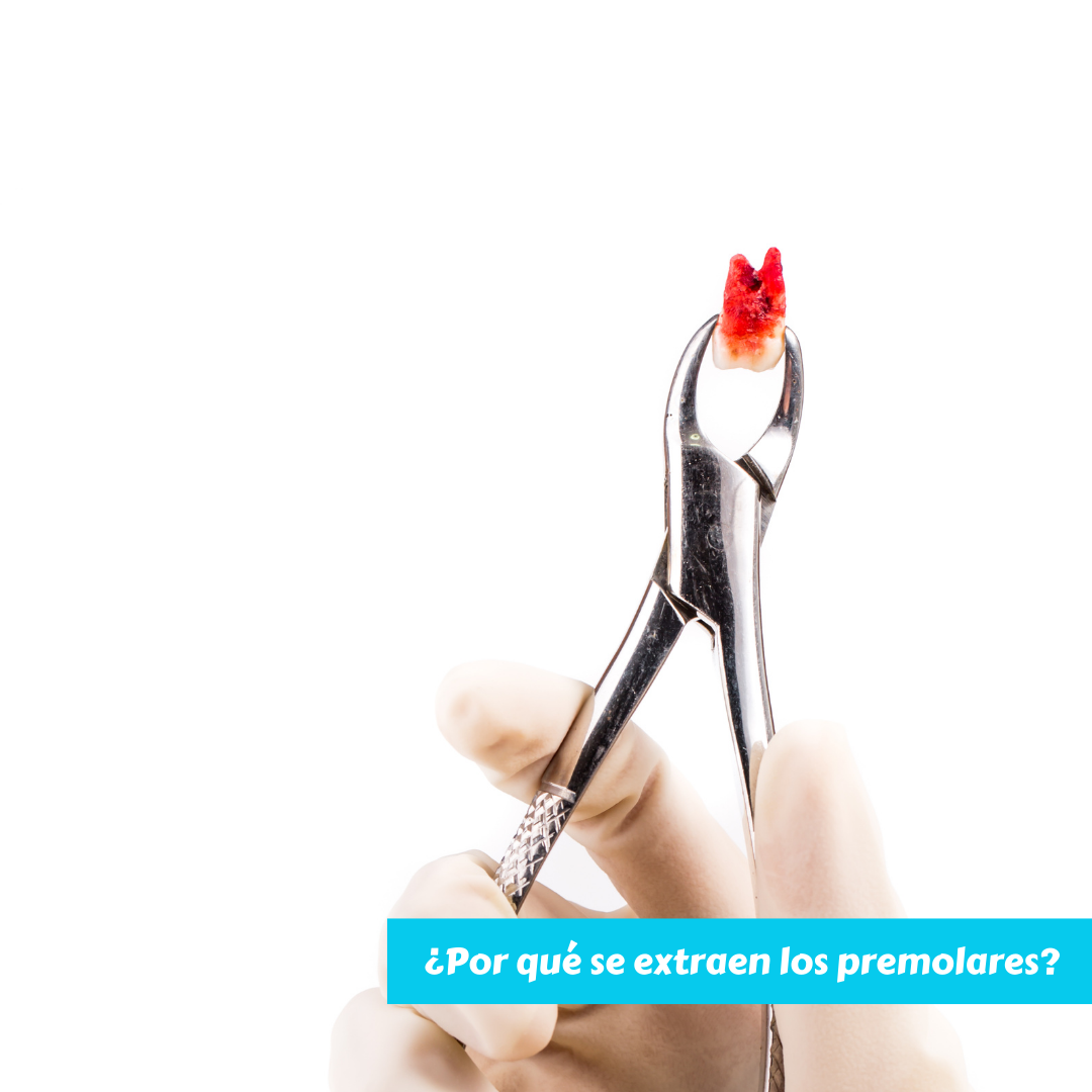 ¿En qué consiste una extracción de premolares y por qué se extraen?