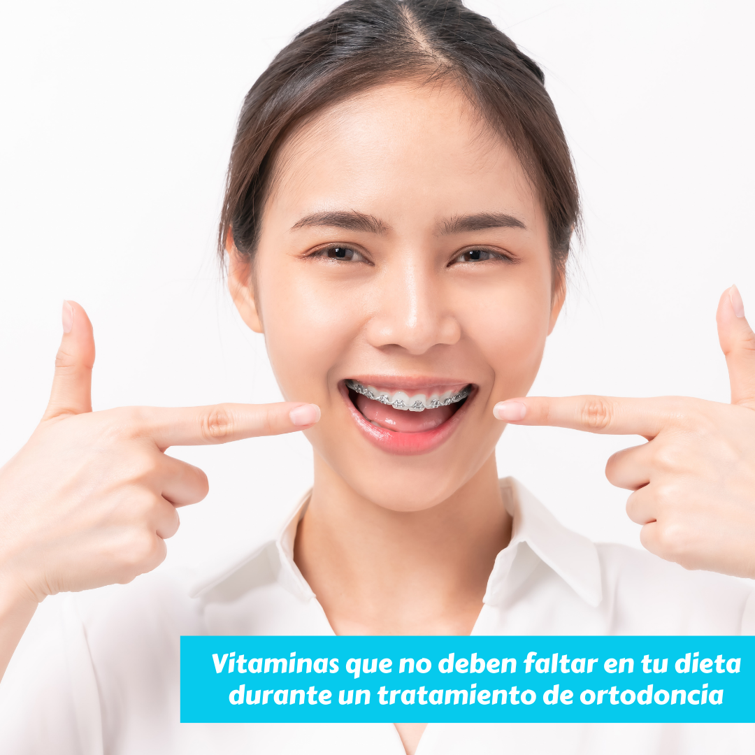 Vitaminas que no deben faltar en tu dieta durante un tratamiento de ortodoncia.
