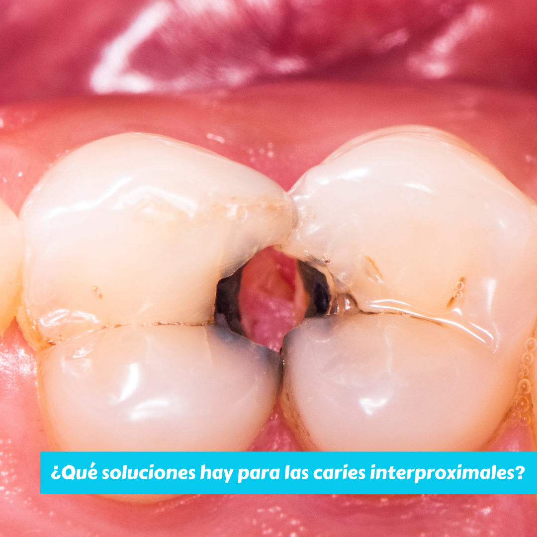 ¿Qué soluciones hay para las caries interproximales?
