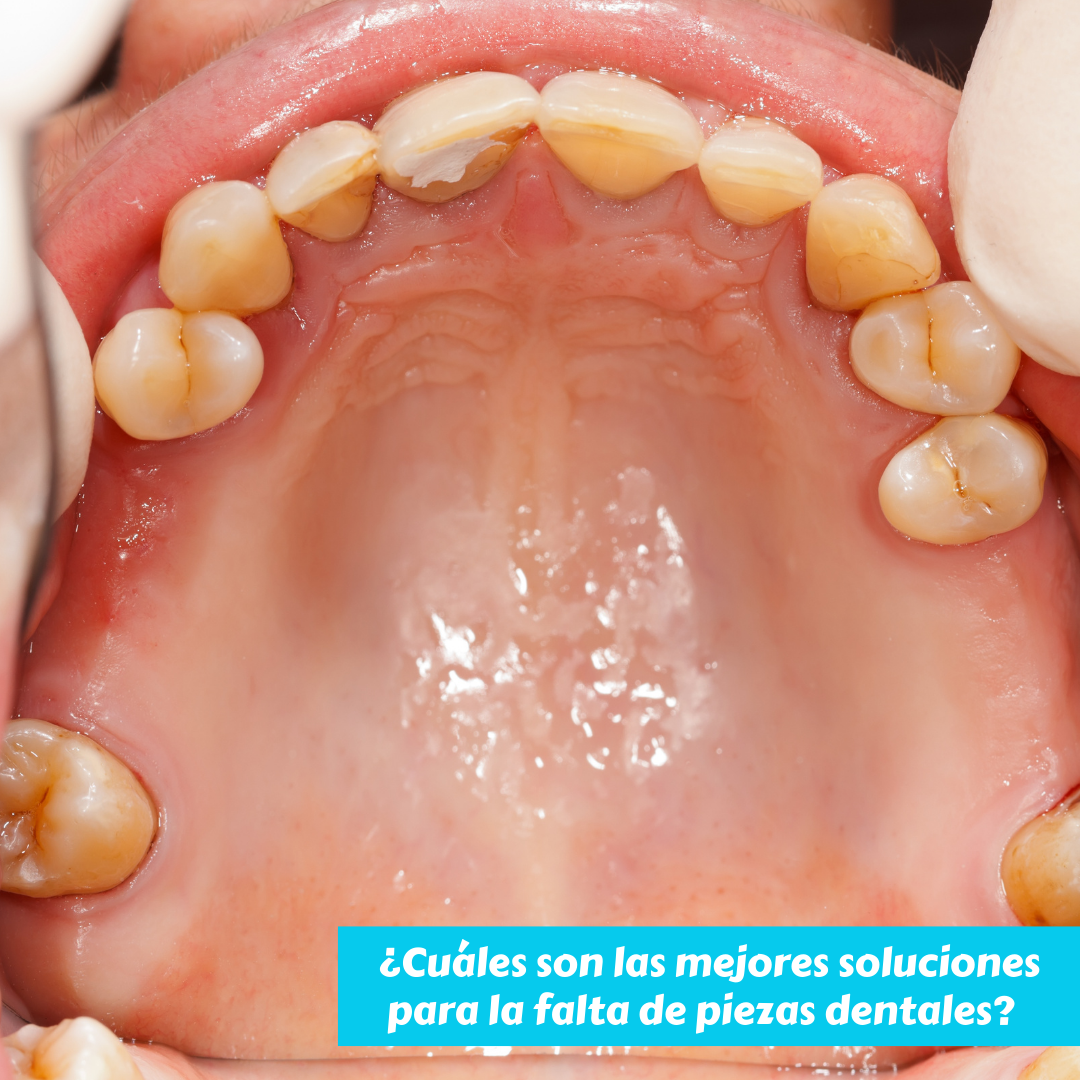 opciones de protesis