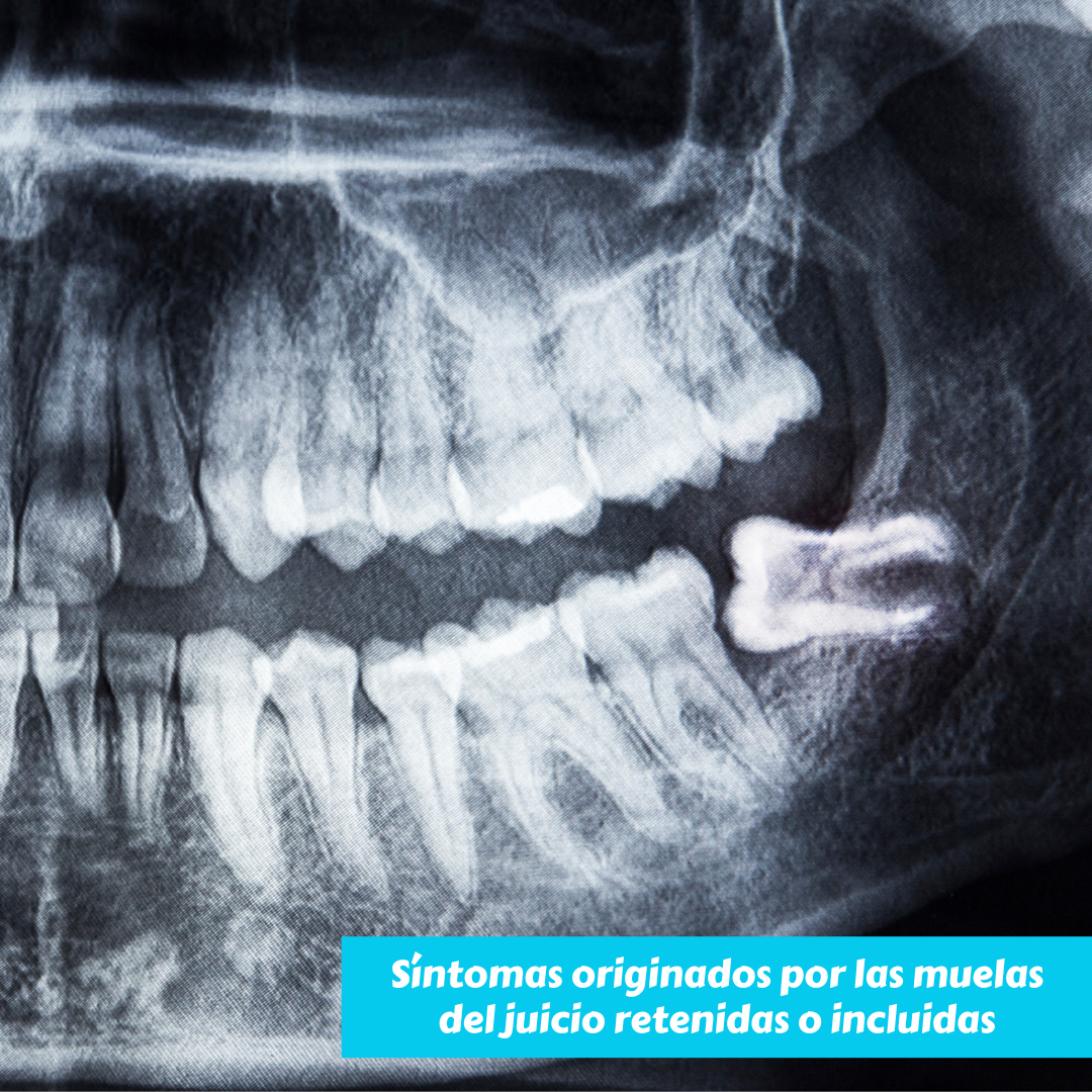síntomas son originados por las muelas del juicio retenidas o incluidas