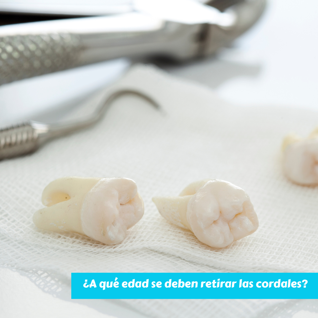 ¿A qué edad se deben retirar las cordales?