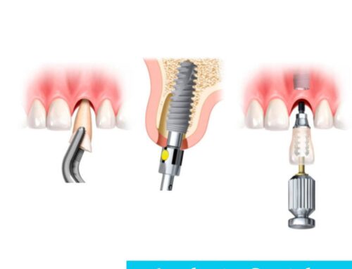 3 preguntas frecuentes sobre implantes dentales