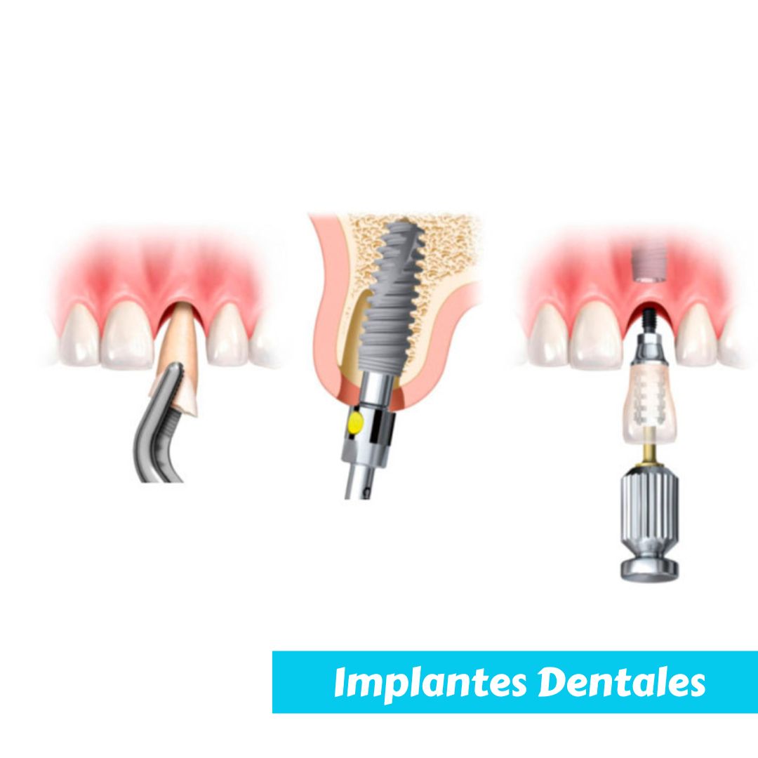 implantes dentales